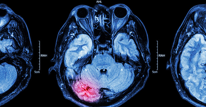 The Importance of Neuroimaging in Concussion Diagnosis and Recovery image